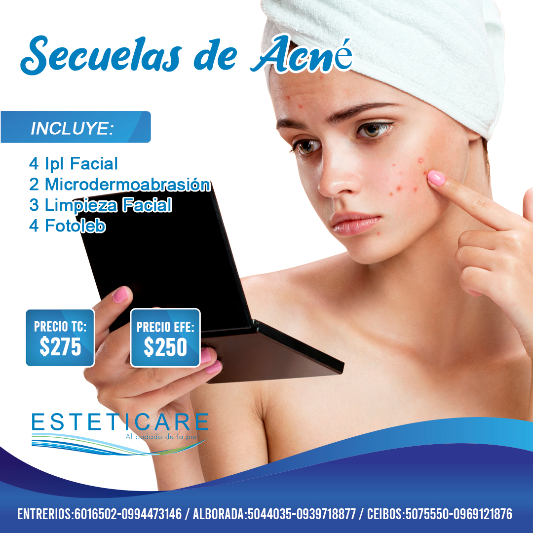 Secuelas de Acné